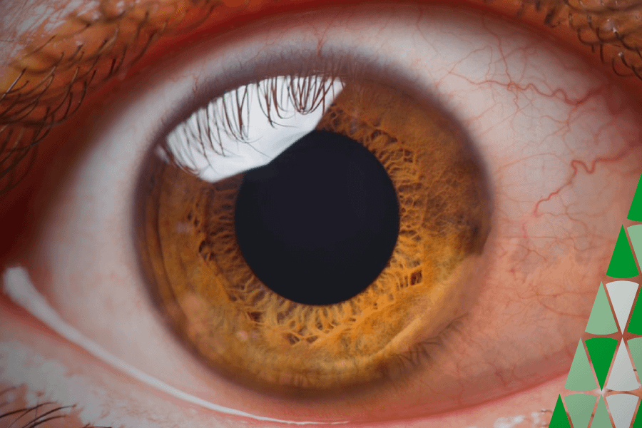 diferenças entre astigmatismo e ceratocone